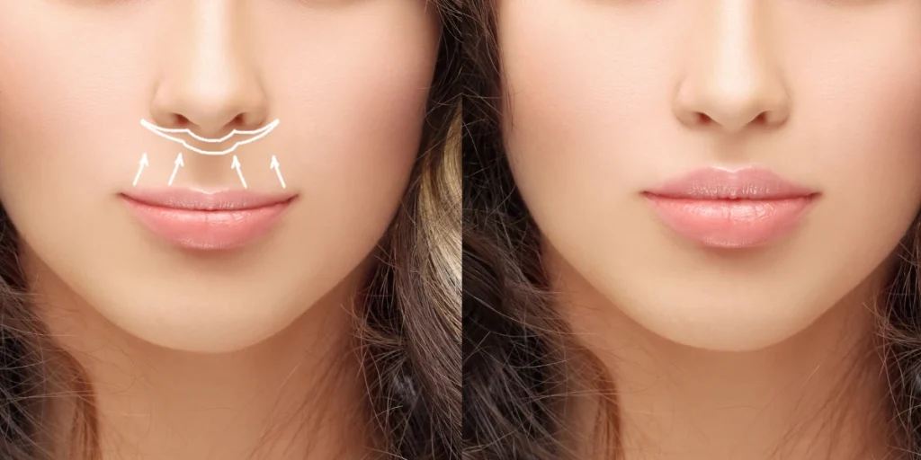 lip filler malaysia​