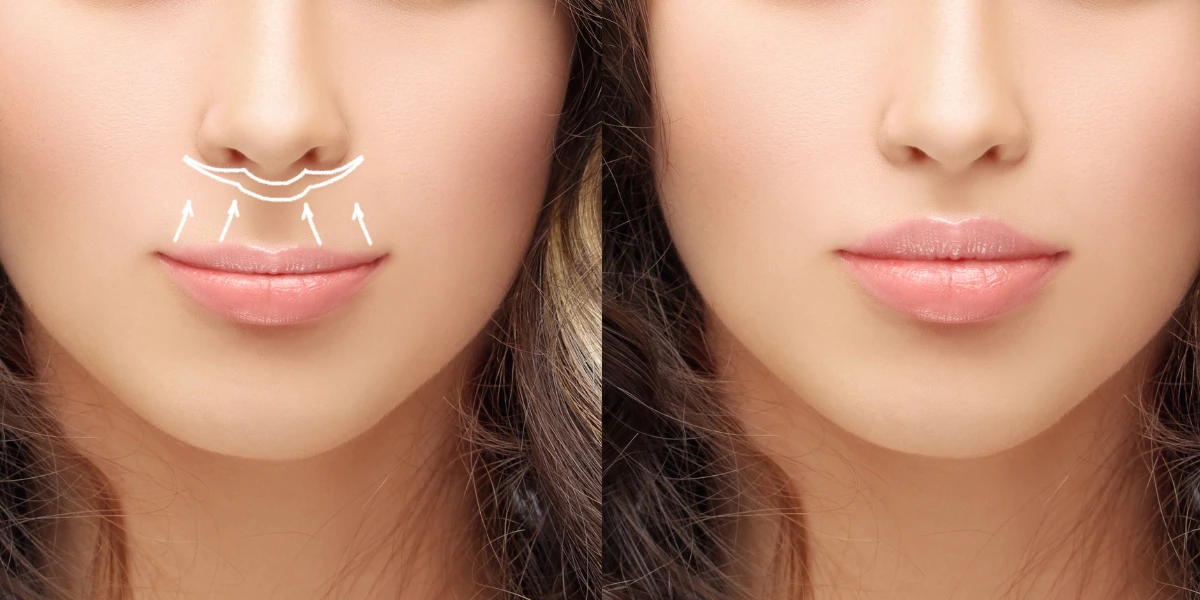 Lip Filler Malaysia Aftercare Tips for Best Results