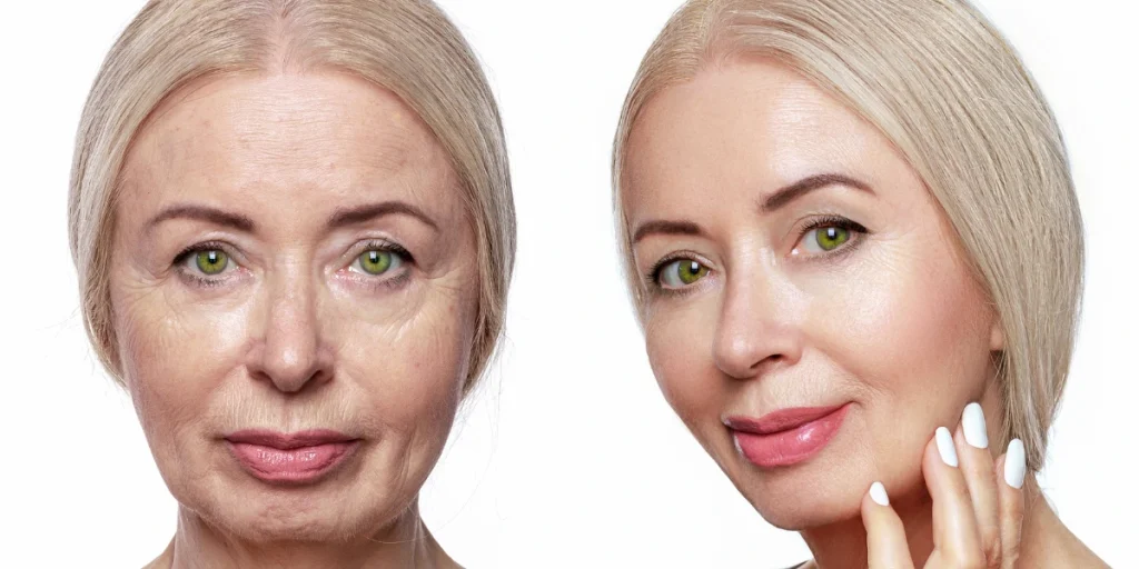 non-surgical face lift